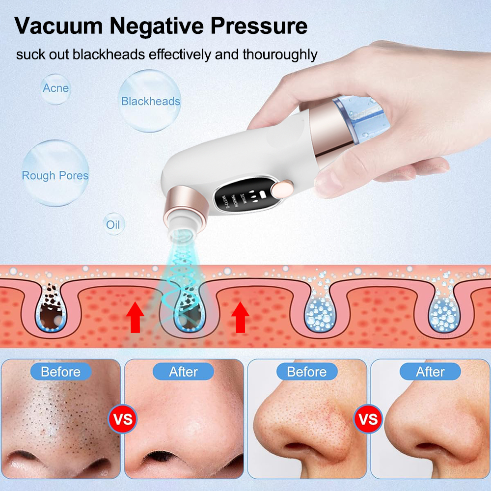 Blackhead Remover Electric Bla - đánh giá và giá Air Bubble Remover